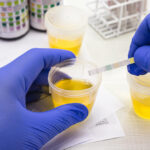 leucociti nelle urine
