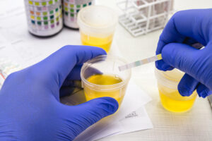 leucociti-nelle-urine-1-300x200