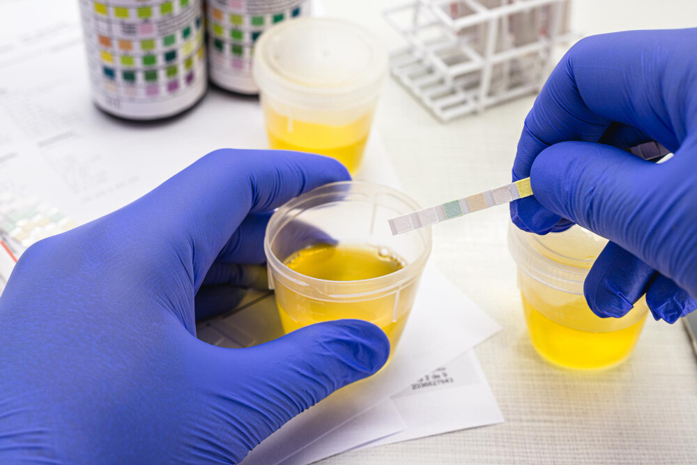 leucociti nelle urine