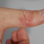 Herpes alle mani: origini, sintomi e cura Salute e benessere 