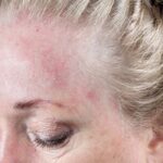 dermatite-seborroica-150x150 I migliori rimedi naturali per la dermatite seborroica I migliori rimedi naturali per la dermatite seborroica Salute e benessere