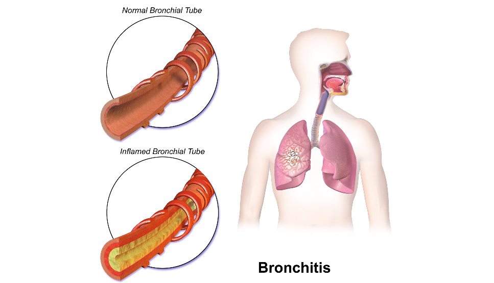 bronchite