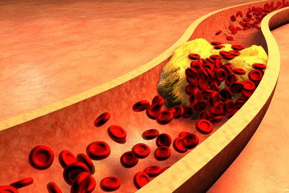 Che cos'è l'ipercolesterolemia? Malattie  