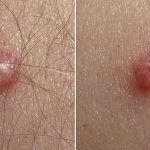 Papilloma virus