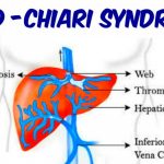 Budd-Chiari