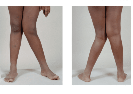 Le gambe storte: gli esercizi per renderle più dritte Salute e benessere 