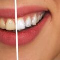 Il bicarbonato sbianca davvero i denti Salute e benessere 