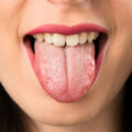 Puntino bianco sulla lingua: cos’è, le cause e i rimedi Malattie Medicina 