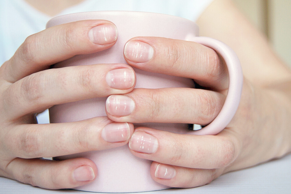 Macchie bianche sulle unghie: cause e trattamento Benessere 