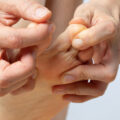 Unghia nera di mani o piedi: cosa fare? Malattie Medicina 