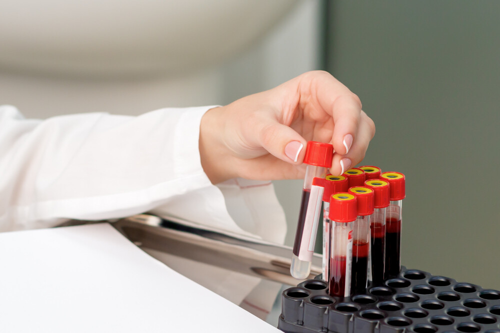 Proteina C reattiva alta nel sangue: quando preoccuparsi Esami Medicina 