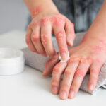 eczema-disidrosico-mani-150x150