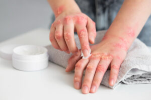 eczema-disidrosico-mani-300x200